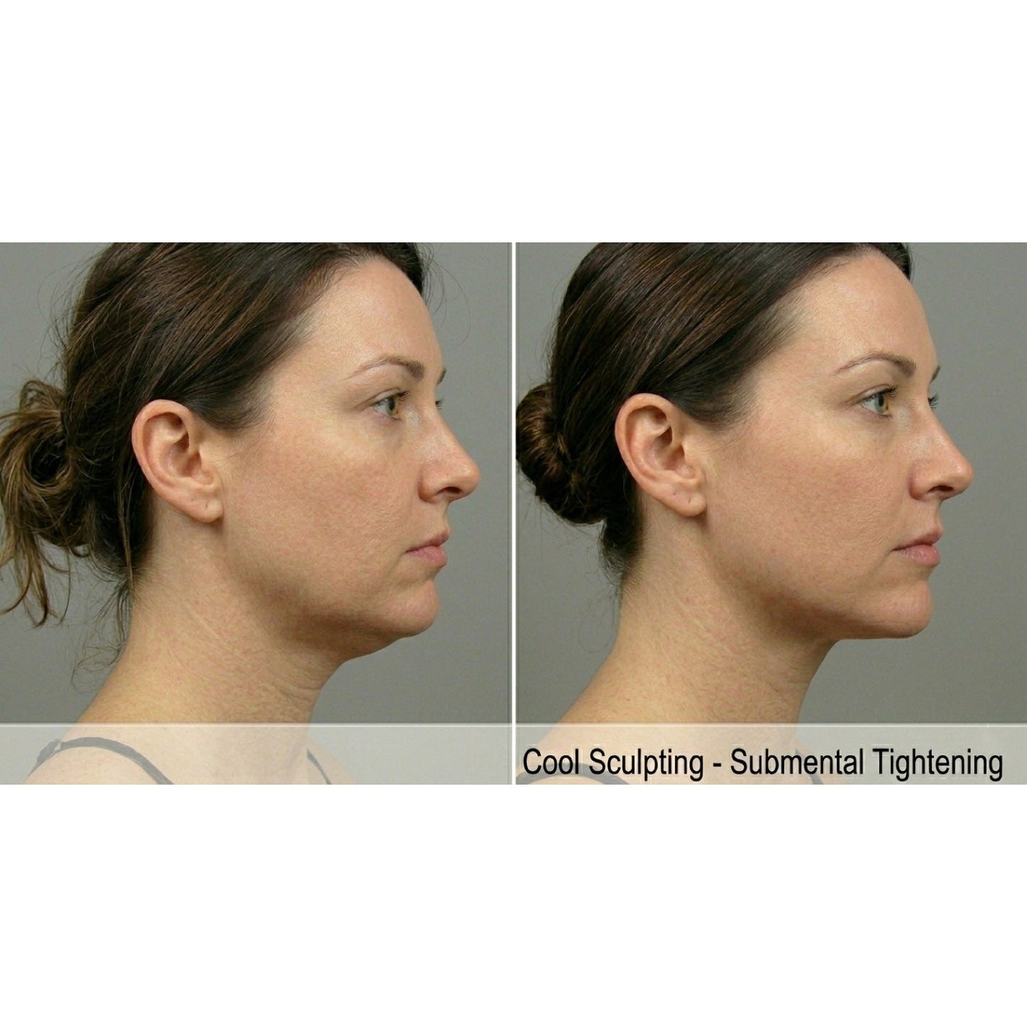 Kavvia CryoShape Cryolipolysis Body Contouring System image 5