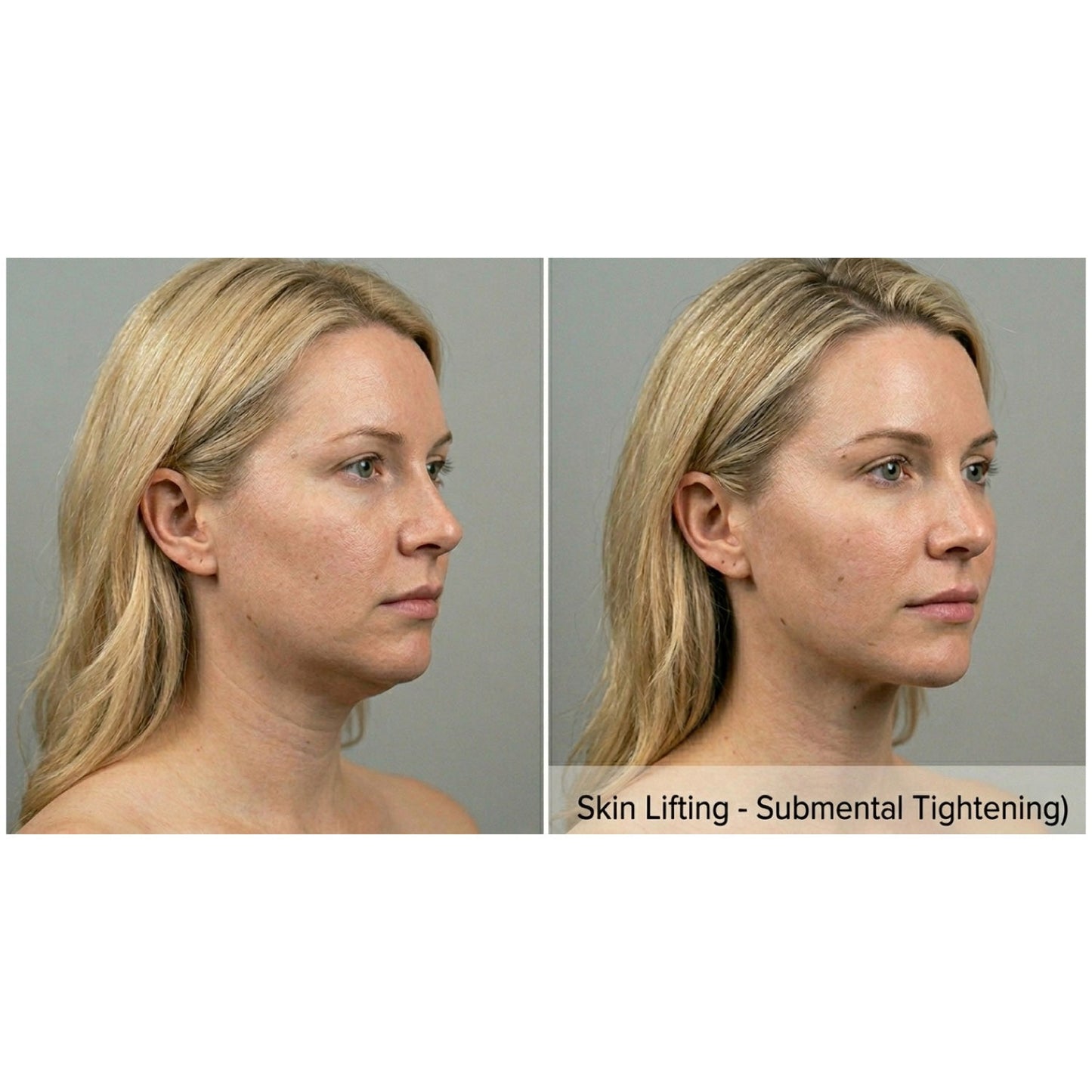 Kavvia Contour X HIFU Body Cavitation System image 5