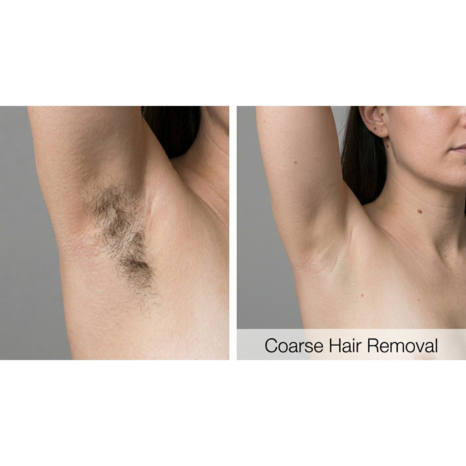 Kavvia Dualis X ND:YAG Laser image 5