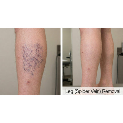 Kavvia Dualis X ND:YAG Laser image 7