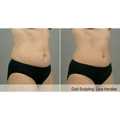 Kavvia CryoShape Cryolipolysis Body Contouring System image 3