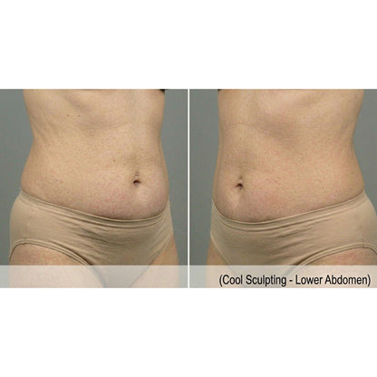 Kavvia CryoShape Cryolipolysis Body Contouring System image 4