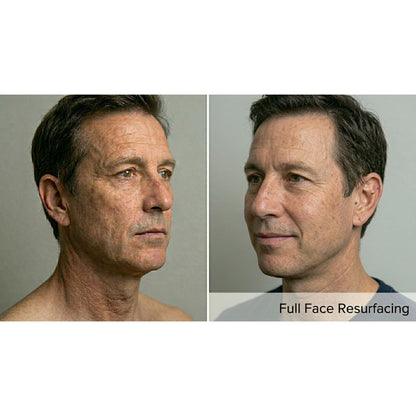 Kavvia Resurf CO2 Fractional Laser image 4