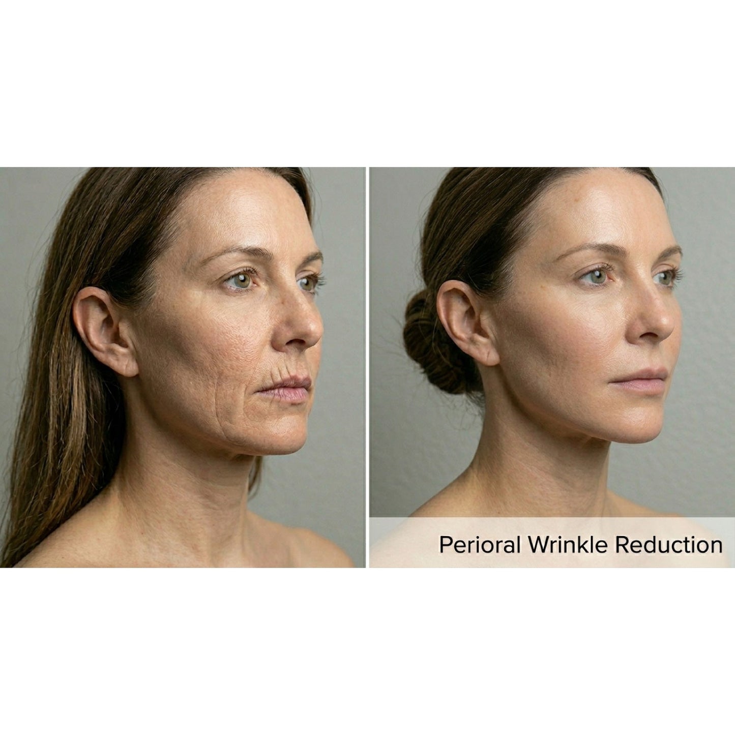 Kavvia Resurf CO2 Fractional Laser image 5