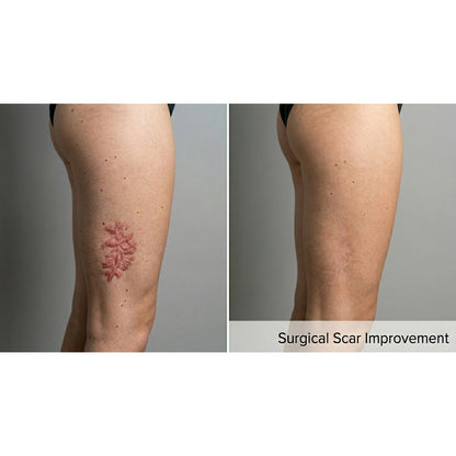 Kavvia Resurf CO2 Fractional Laser image 6