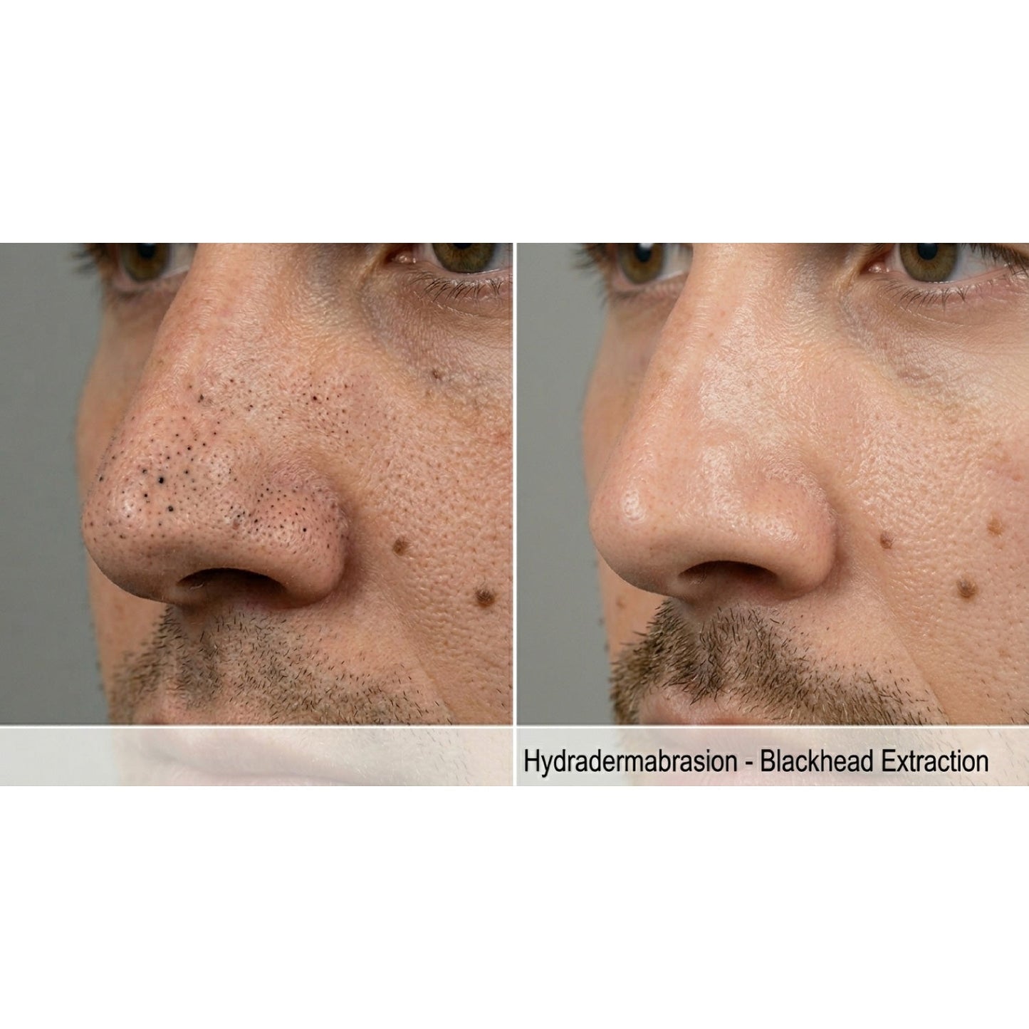 Kavvia HydraGlow Hydradermabrasion System image 3