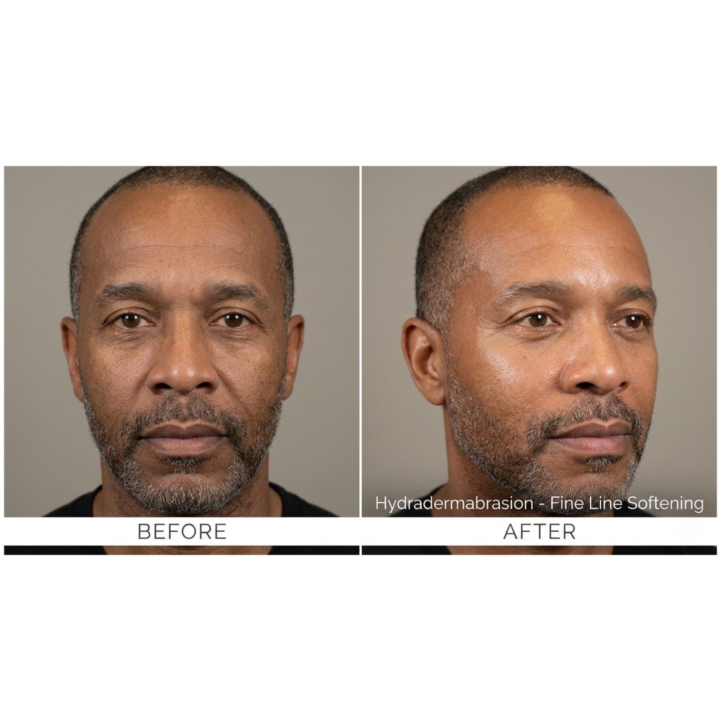 Kavvia HydraGlow Hydradermabrasion System image 4