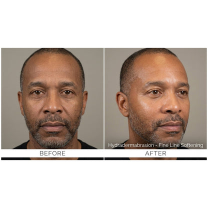 Kavvia HydraGlow Hydradermabrasion System image 4