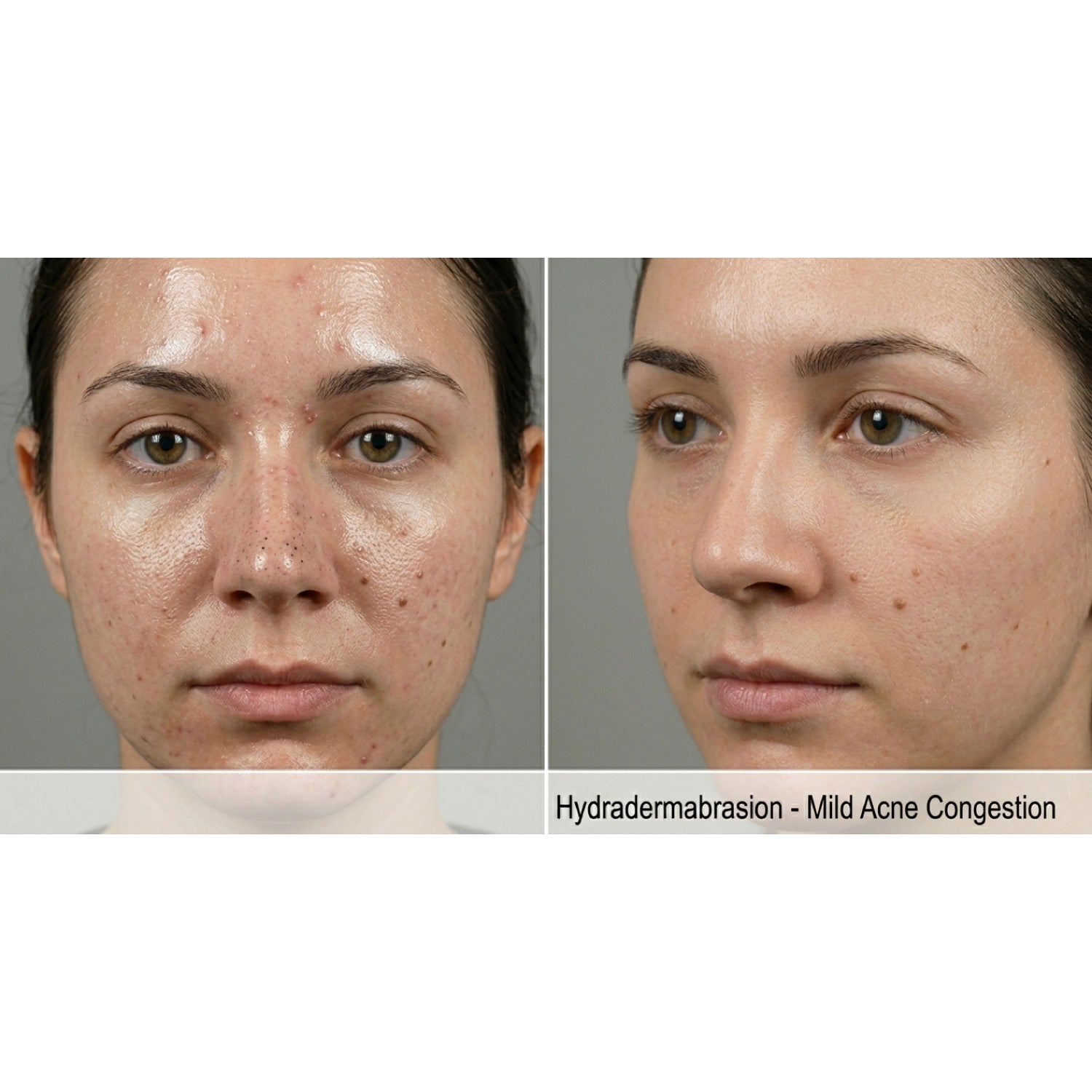 Kavvia HydraGlow Hydradermabrasion System image 5