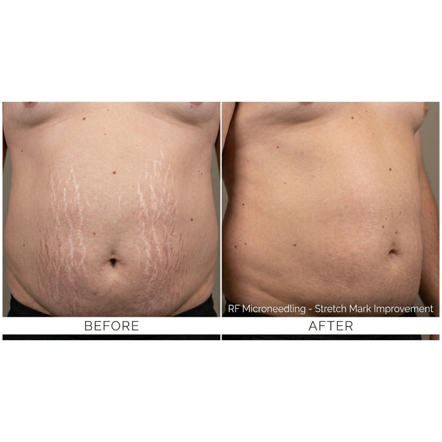 Kavvia Firm X RF Microneedling Device image 9