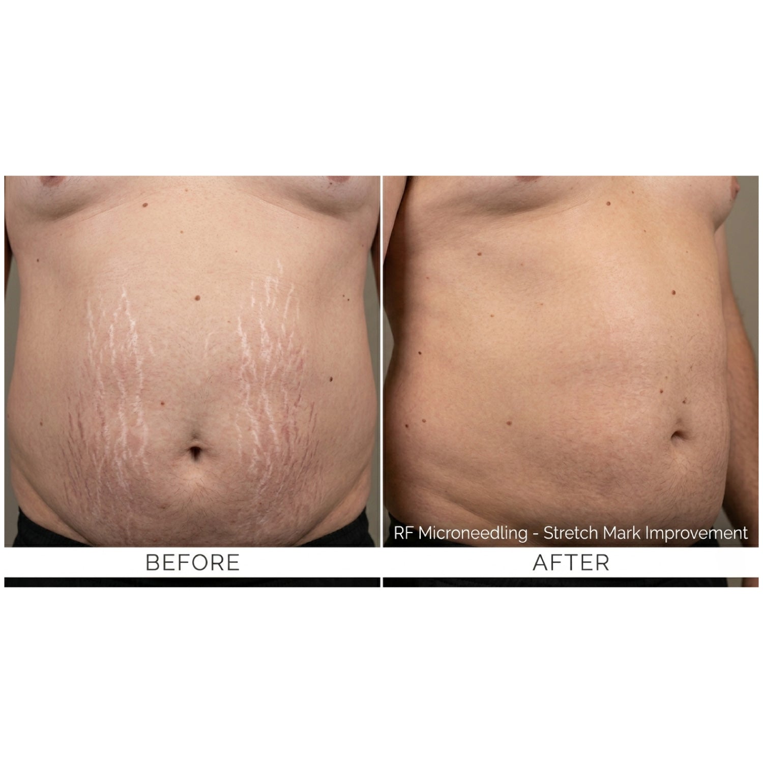 Kavvia Firm X RF Microneedling Device image 9
