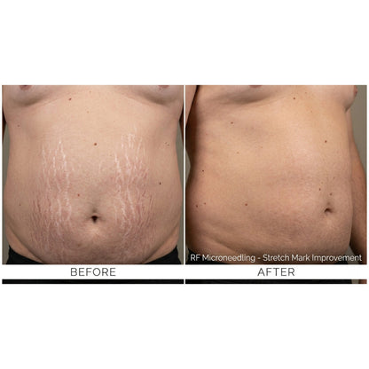 Kavvia Firm X RF Microneedling Device image 9