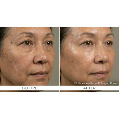 Kavvia Firm X RF Microneedling Device image 10