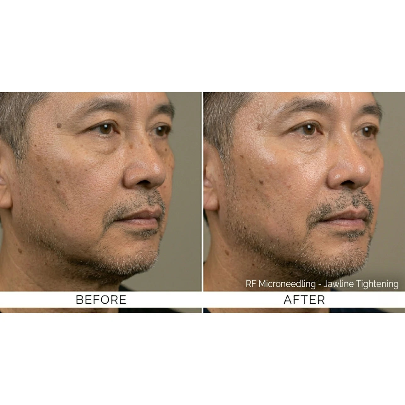 Kavvia Firm X RF Microneedling Device image 12