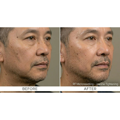 Kavvia Firm X RF Microneedling Device image 12